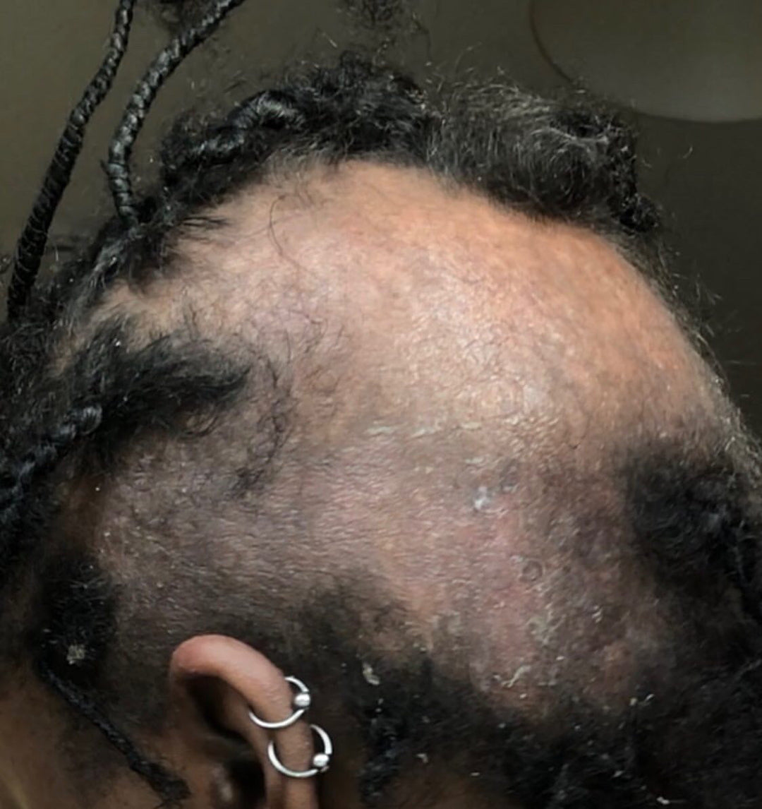Hair Loss Management Products