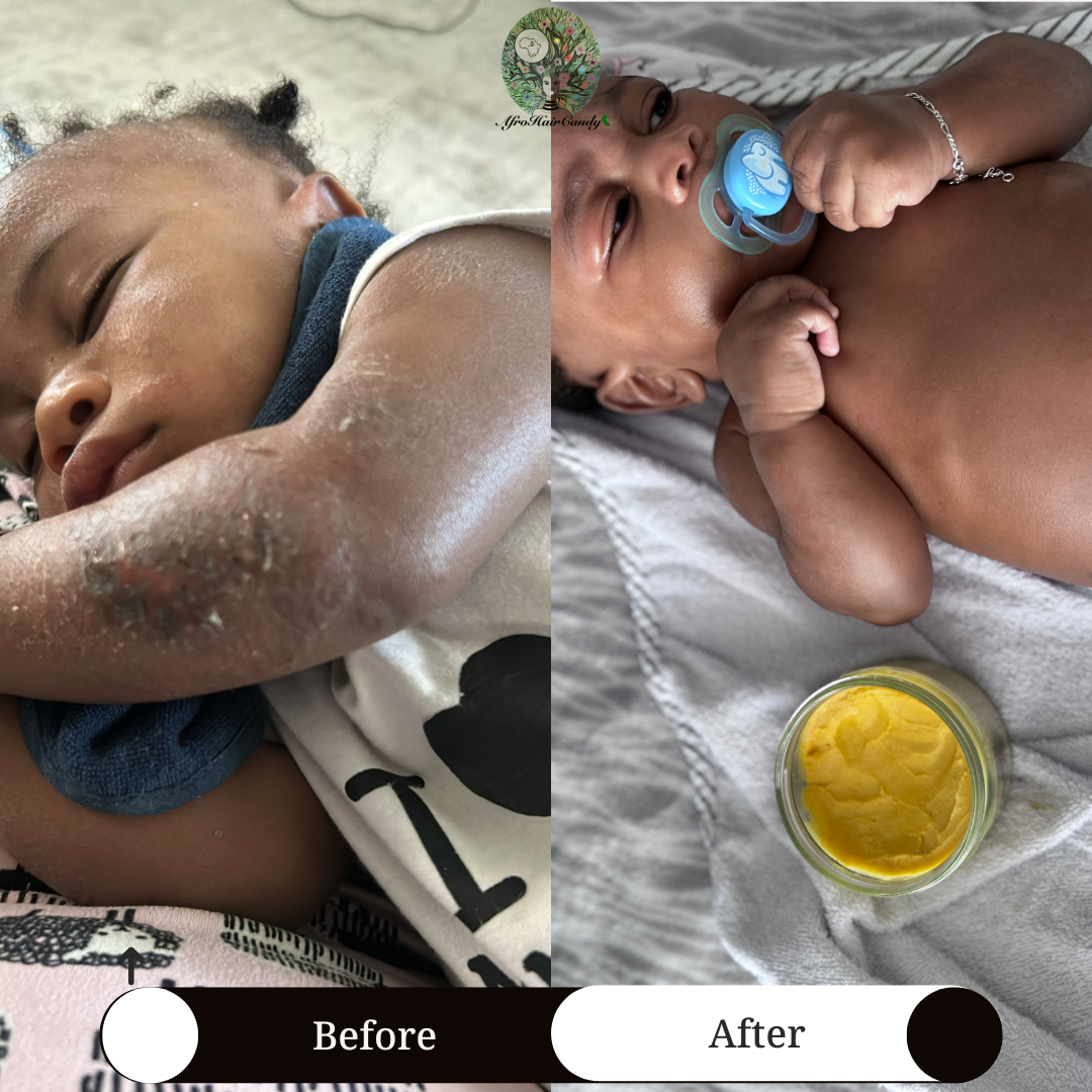 Eczema Care