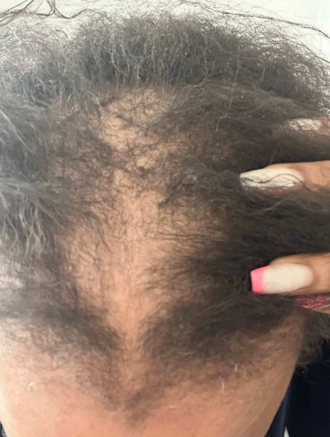 Scalp Restoration — Natural Hair Loss Treatment
