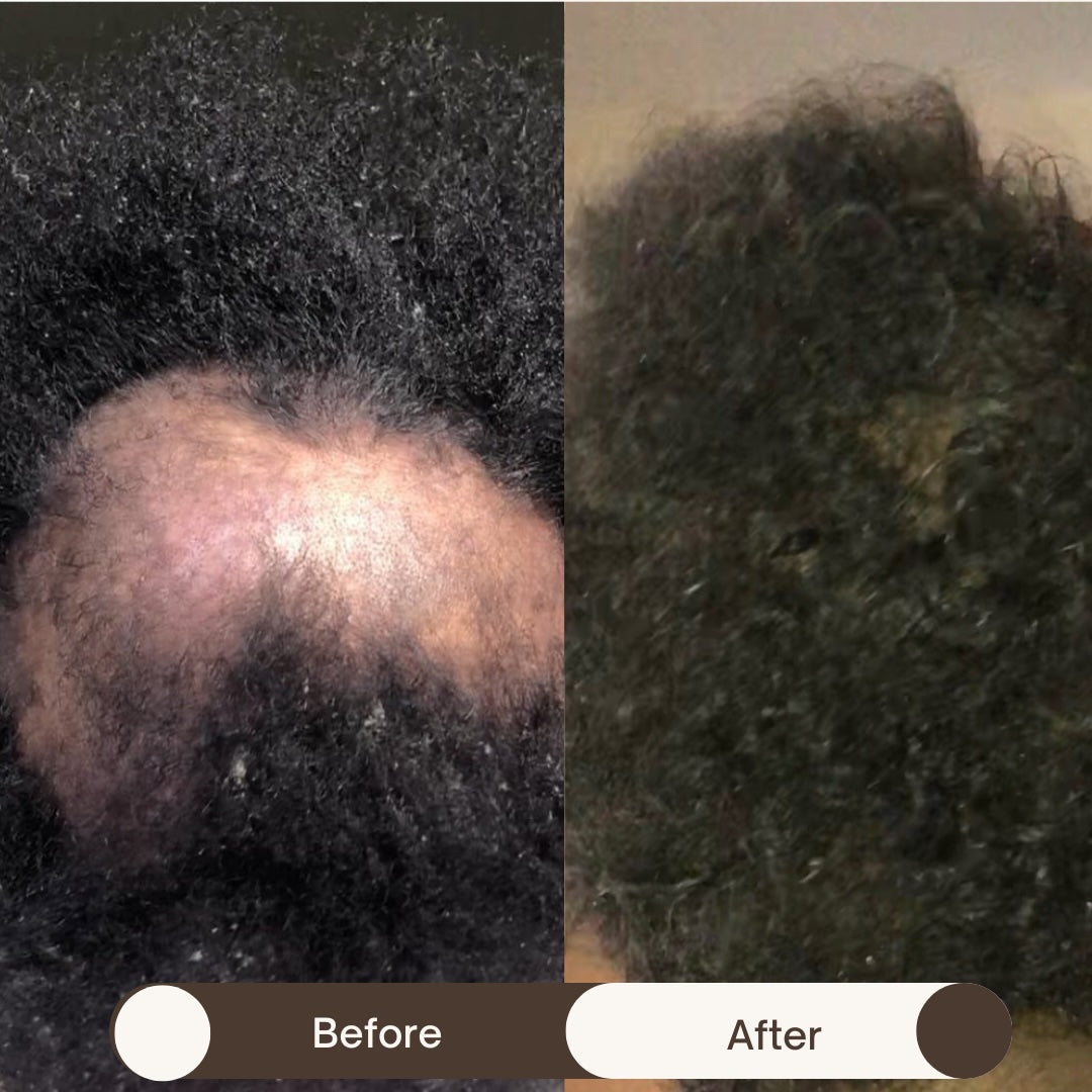 Female Hair Loss Treatment