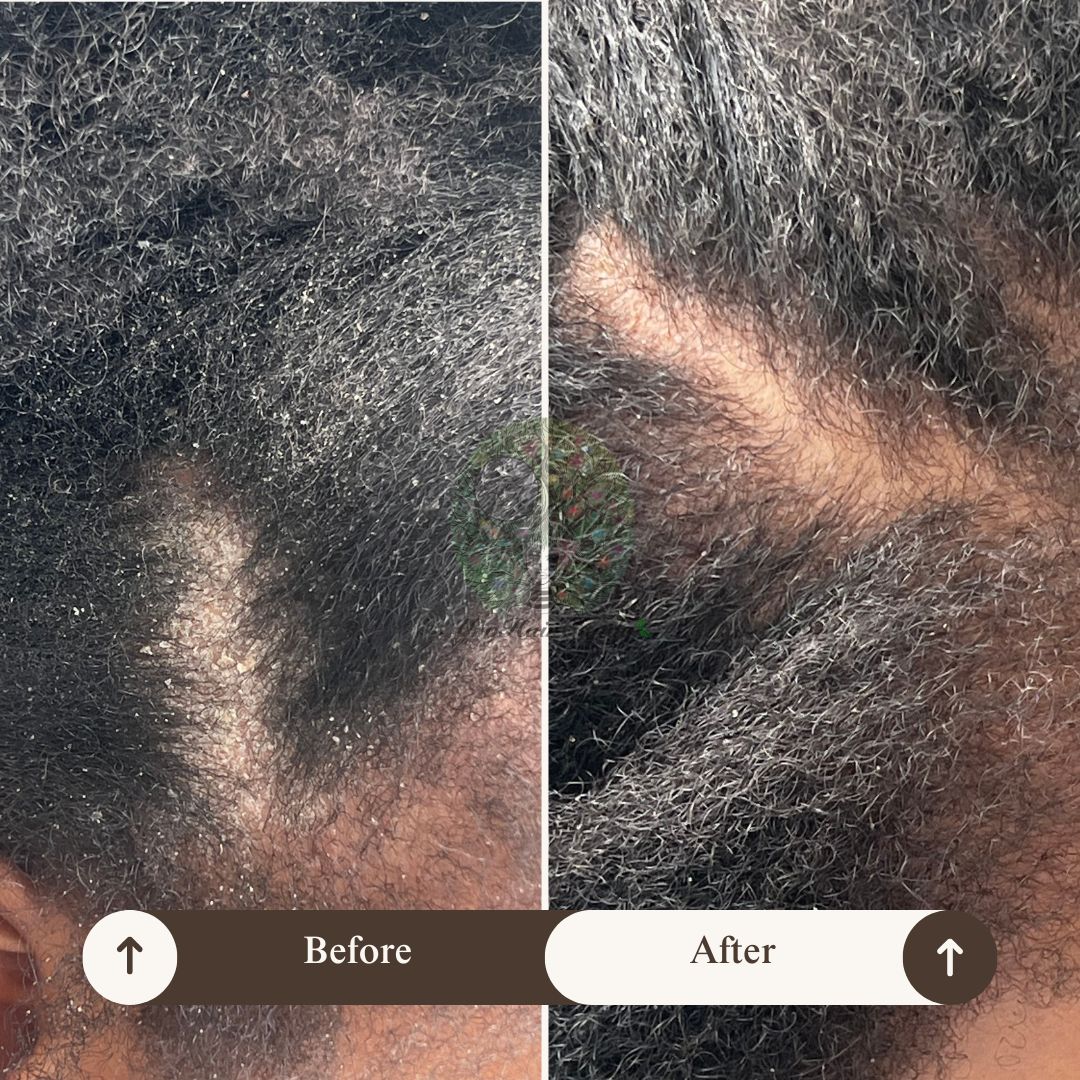 Scalp Renewal Therapy System